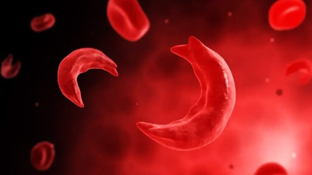 World Sickle Cell Day 2024: