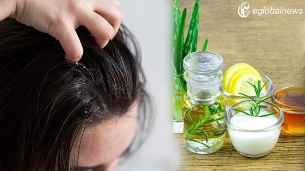 Dandruff Problem: